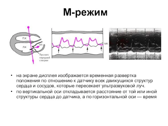 М-режим на экране дисплея изображается временная развертка положения по отношению к