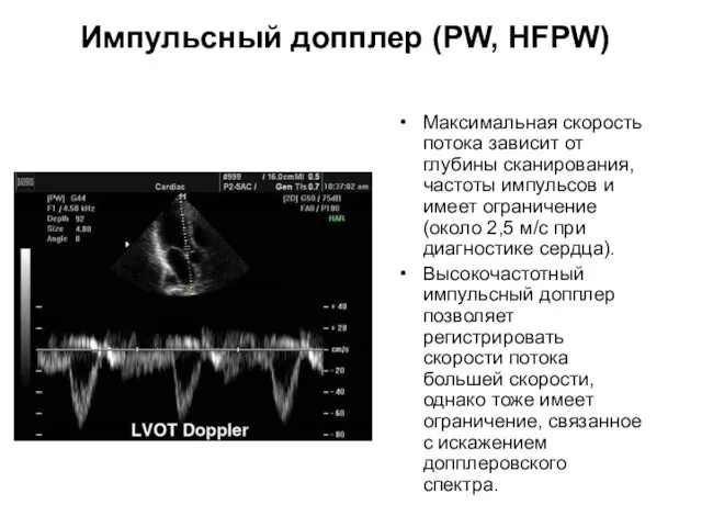 Импульсный допплер (PW, HFPW) Максимальная скорость потока зависит от глубины сканирования,