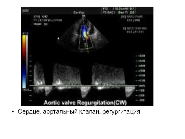 Сердце, аортальный клапан, регургитация