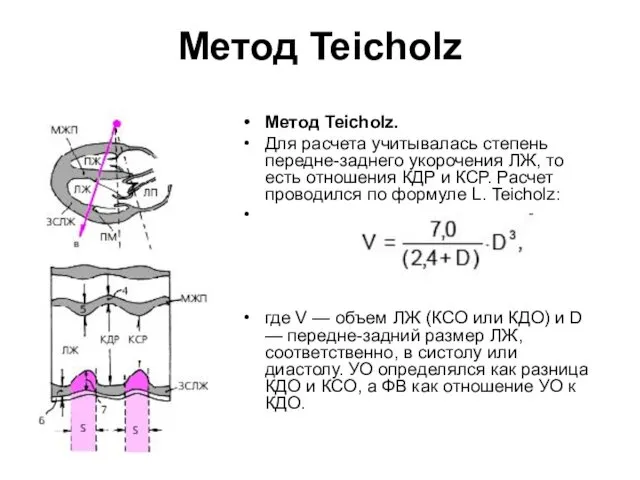 Метод Teicholz Метод Teicholz. Для расчета учитывалась степень передне-заднего укорочения ЛЖ,