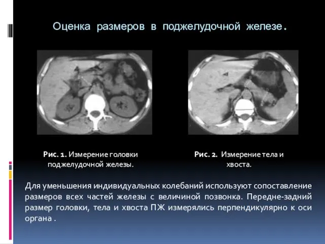 Оценка размеров в поджелудочной железе. Рис. 1. Измерение головки поджелудочной железы.