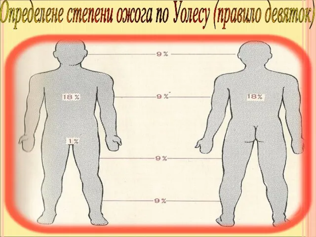 Определене степени ожога по Уолесу (правило девяток)