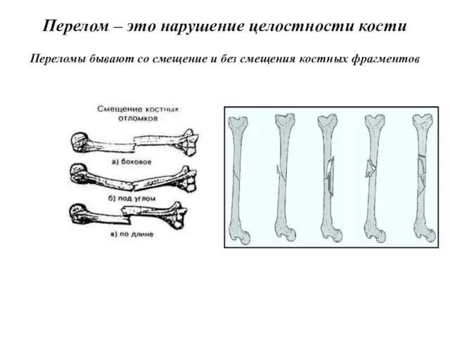 Перелом – это нарушение целостности кости Переломы бывают со смещение и без смещения костных фрагментов