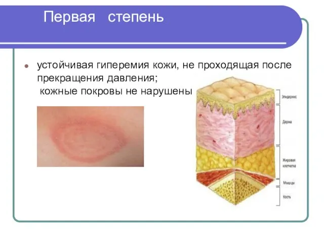 Первая степень устойчивая гиперемия кожи, не проходящая после прекращения давления; кожные покровы не нарушены.