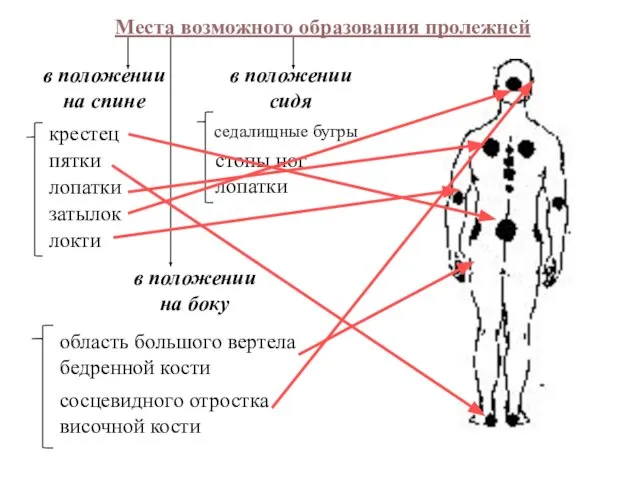 Места возможного образования пролежней в положении на спине в положении сидя