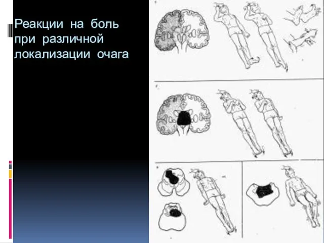 Реакции на боль при различной локализации очага