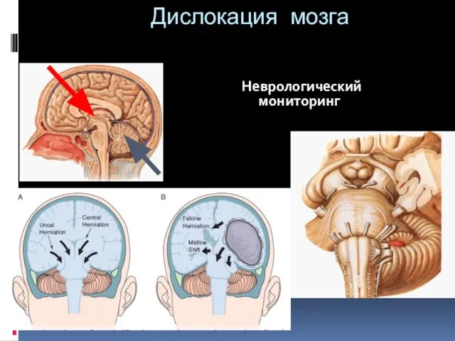 Дислокация мозга Неврологический мониторинг
