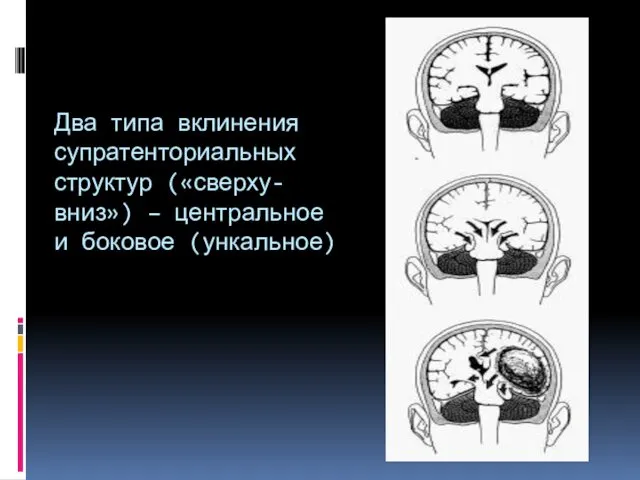 Два типа вклинения супратенториальных структур («сверху-вниз») – центральное и боковое (ункальное)