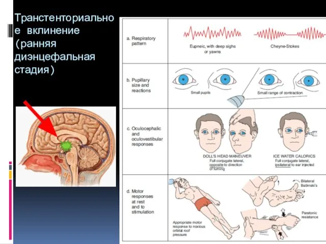 Транстенториальное вклинение (ранняя диэнцефальная стадия)