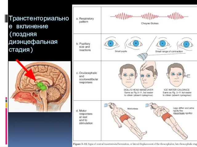 Транстенториальное вклинение (поздняя диэнцефальная стадия)