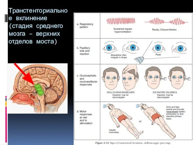 Транстенториальное вклинение (стадия среднего мозга – верхних отделов моста)