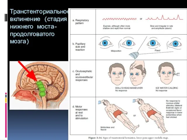 Транстенториальное вклинение (стадия нижнего моста-продолговатого мозга)