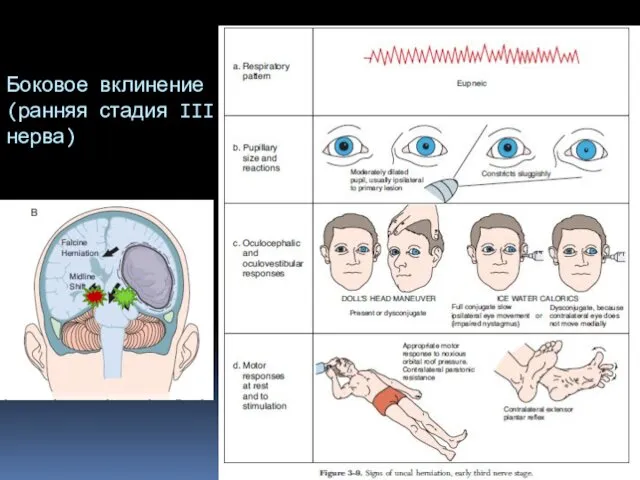 Боковое вклинение (ранняя стадия III нерва)