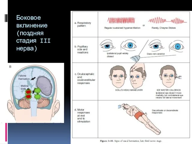 Боковое вклинение (поздняя стадия III нерва)