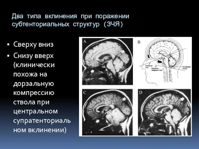 Два типа вклинения при поражении субтенториальных структур (ЗЧЯ) Сверху вниз Снизу