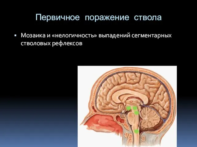 Первичное поражение ствола Мозаика и «нелогичность» выпадений сегментарных стволовых рефлексов