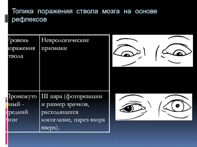 Топика поражения ствола мозга на основе рефлексов