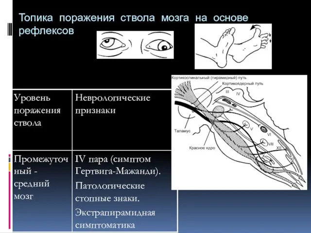 Топика поражения ствола мозга на основе рефлексов