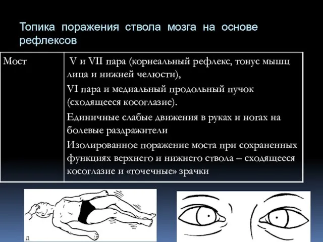 Топика поражения ствола мозга на основе рефлексов