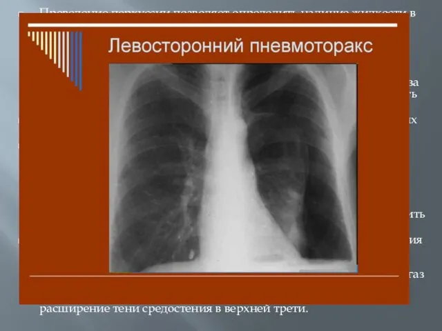 Проведение перкуссии позволяет определить наличие жидкости в плевральной полости по укорочению