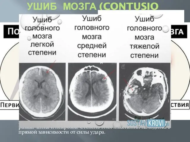 УШИБ МОЗГА (CONTUSIO CEREBRI) Между ушибом и чистой формой сотрясения головного