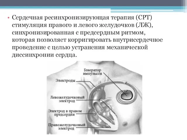 Сердечная ресинхронизирующая терапия (СРТ) стимуляция правого и левого желудочков (ЛЖ), синхронизированная