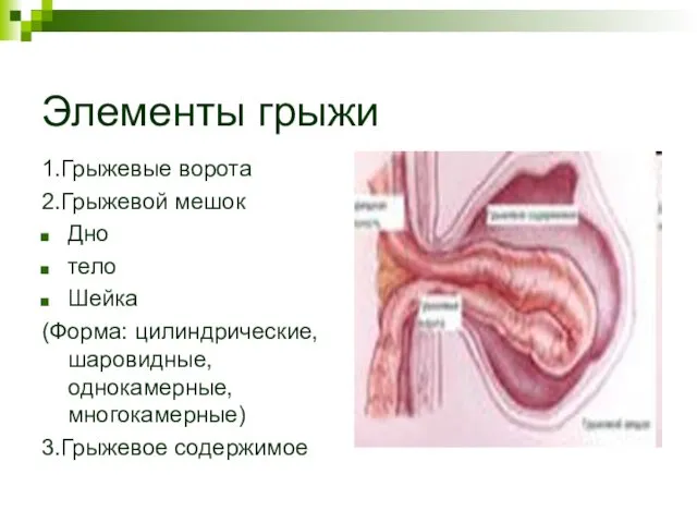 Элементы грыжи 1.Грыжевые ворота 2.Грыжевой мешок Дно тело Шейка (Форма: цилиндрические, шаровидные, однокамерные, многокамерные) 3.Грыжевое содержимое