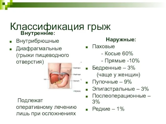 Классификация грыж Внутренние: Внутрибрюшные Диафрагмальные (грыжи пищеводного отверстия) Подлежат оперативному лечению