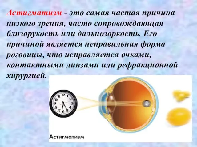 Астигматизм - это самая частая причина низкого зрения, часто сопровождающая близорукость