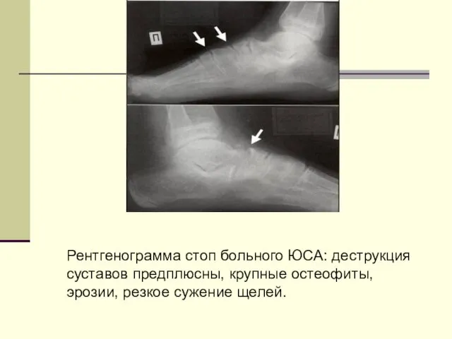 Рентгенограмма стоп больного ЮСА: деструкция суставов предплюсны, крупные остеофиты, эрозии, резкое сужение щелей.