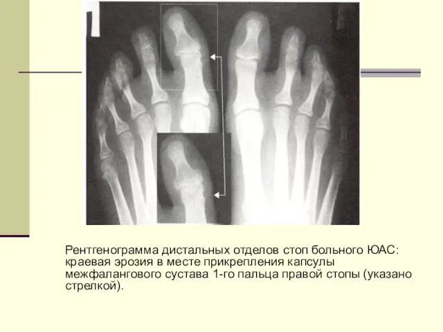 Рентгенограмма дистальных отделов стоп больного ЮАС: краевая эрозия в месте прикрепления