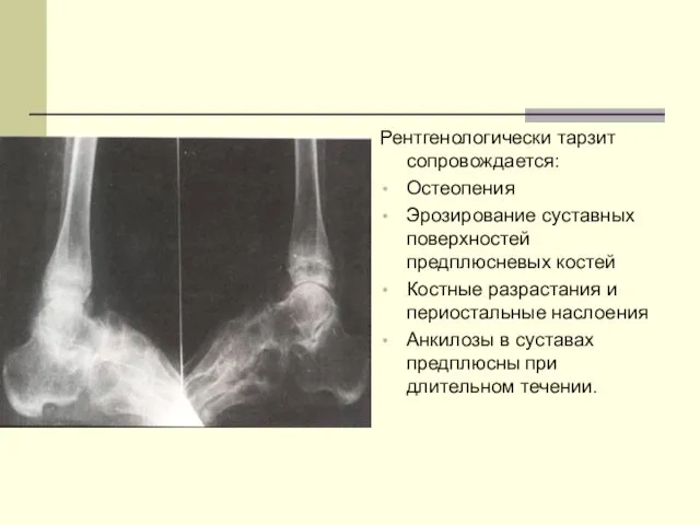Рентгенологически тарзит сопровождается: Остеопения Эрозирование суставных поверхностей предплюсневых костей Костные разрастания