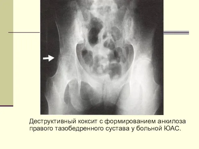 Деструктивный коксит с формированием анкилоза правого тазобедренного сустава у больной ЮАС.