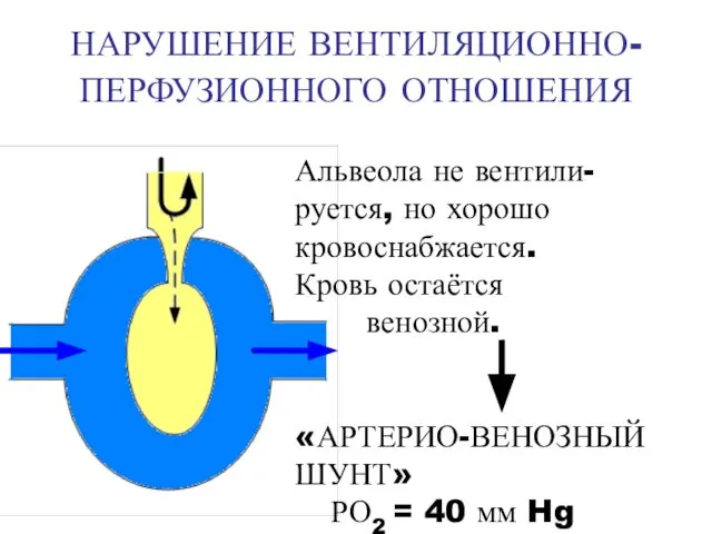 НАРУШЕНИЕ ВЕНТИЛЯЦИОННО-ПЕРФУЗИОННОГО ОТНОШЕНИЯ Альвеола не вентили- руется, но хорошо кровоснабжается. Кровь