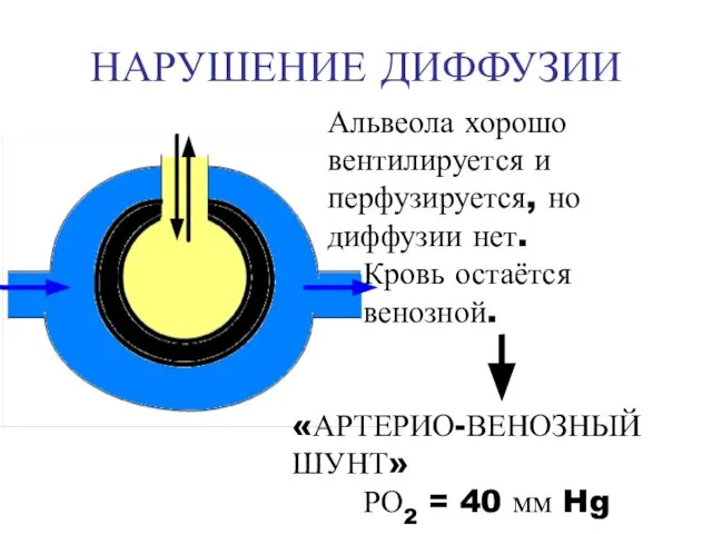 НАРУШЕНИЕ ДИФФУЗИИ Альвеола хорошо вентилируется и перфузируется, но диффузии нет. Кровь