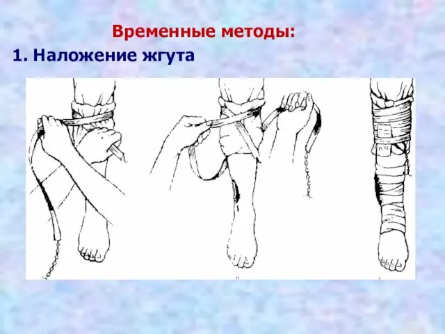 Временные методы: 1. Наложение жгута