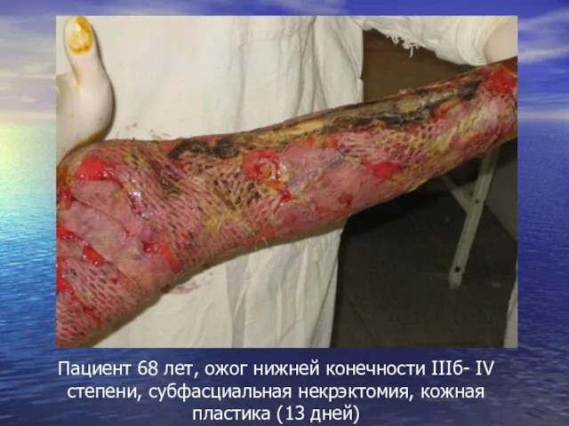 Пациент 68 лет, ожог нижней конечности IIIб- IV степени, субфасциальная некрэктомия, кожная пластика (13 дней)