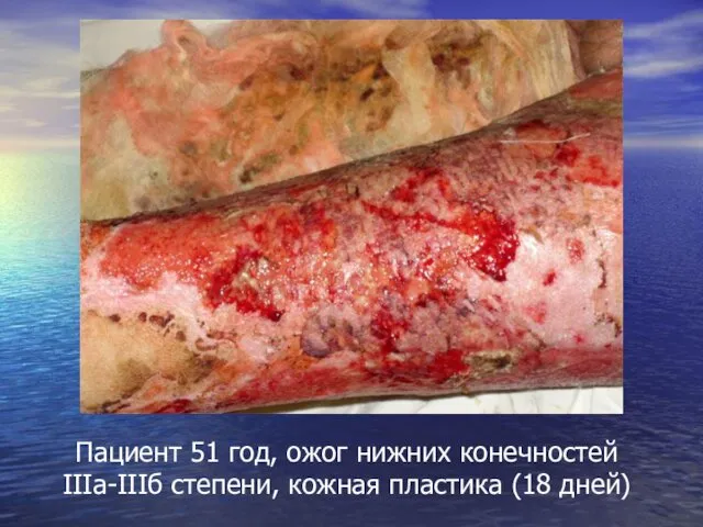 Пациент 51 год, ожог нижних конечностей IIIа-IIIб степени, кожная пластика (18 дней)