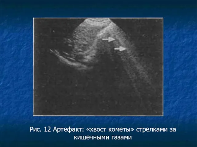 Рис. 12 Артефакт: «хвост кометы» стрелками за кишечными газами