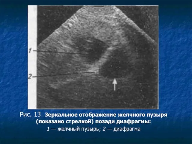 Рис. 13 Зеркальное отображение желч­ного пузыря (показано стрелкой) позади диафрагмы: 1