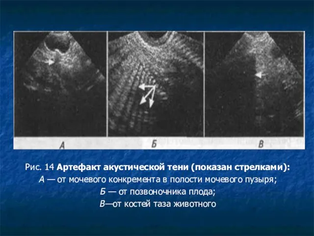 Рис. 14 Артефакт акустической тени (показан стрелками): А — от мочевого