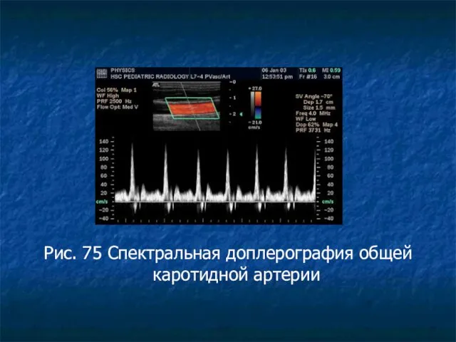 Рис. 75 Спектральная доплерография общей каротидной артерии