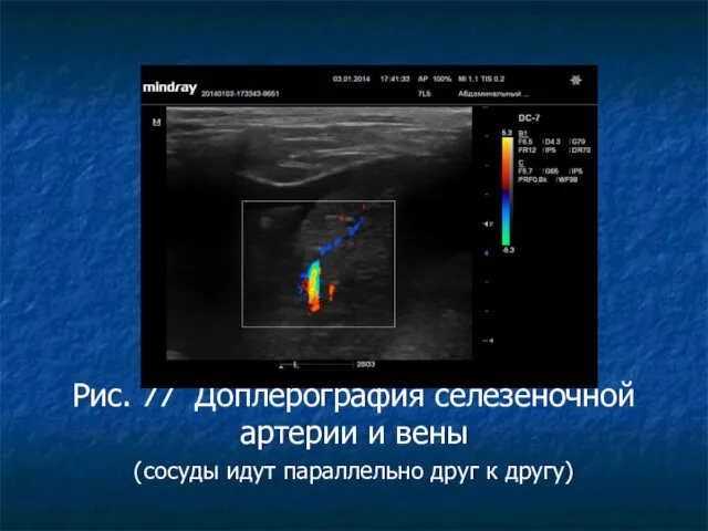 Рис. 77 Доплерография селезеночной артерии и вены (сосуды идут параллельно друг к другу)