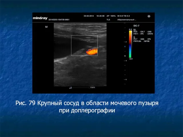 Рис. 79 Крупный сосуд в области мочевого пузыря при доплерографии