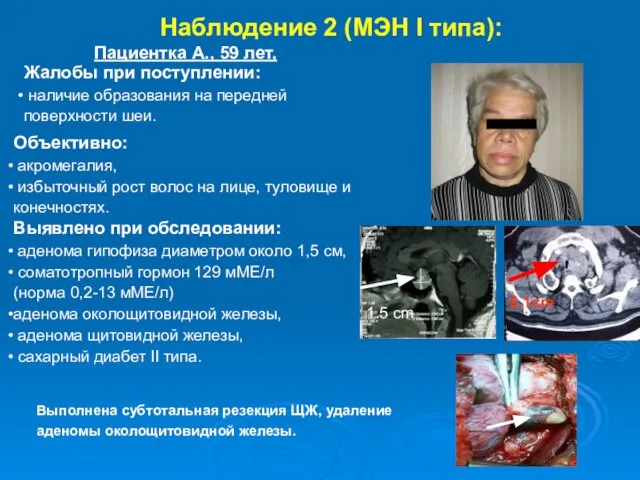 Наблюдение 2 (МЭН I типа): Пациентка А., 59 лет, Жалобы при