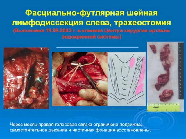 Фасциально-футлярная шейная лимфодиссекция слева, трахеостомия (Выполнена 19.09.2003 г. в клинике Центра