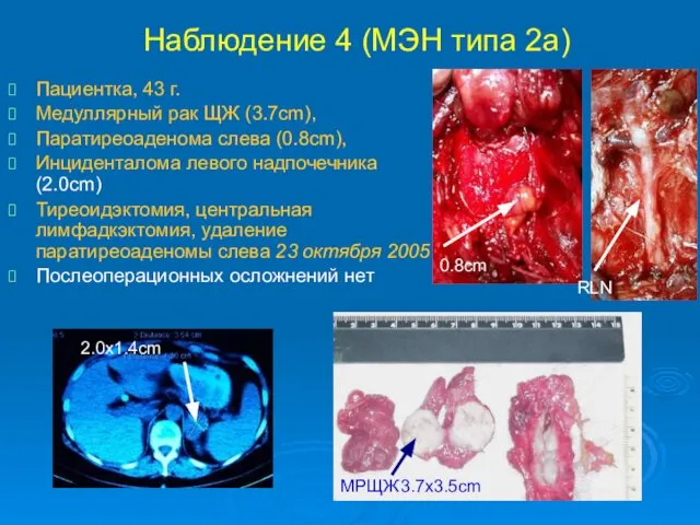 Наблюдение 4 (МЭН типа 2а) Пациентка, 43 г. Медуллярный рак ЩЖ