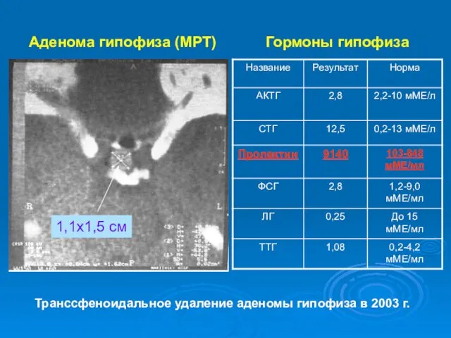 Аденома гипофиза (МРТ) 1,1х1,5 см Гормоны гипофиза Транссфеноидальное удаление аденомы гипофиза в 2003 г.