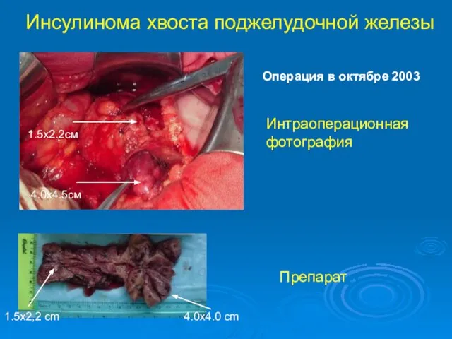 Инсулинома хвоста поджелудочной железы 4.0х4.5см 1.5х2.2см Интраоперационная фотография Препарат 4.0х4.0 cm