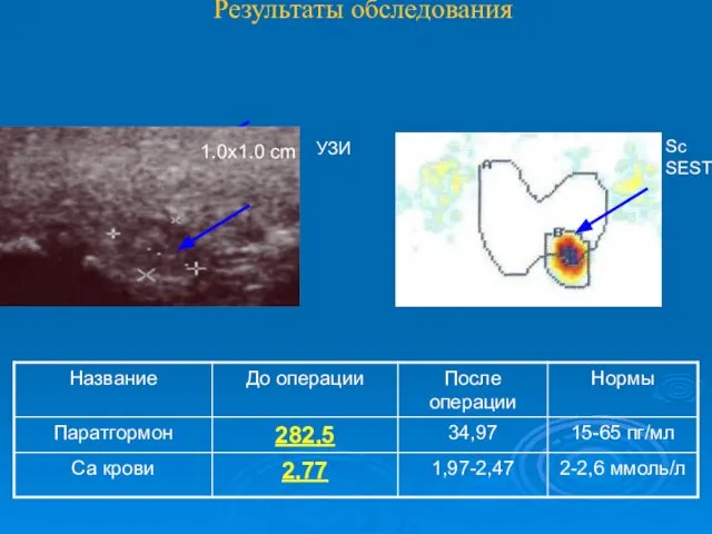 Результаты обследования УЗИ Sc SEST 1.0x1.0 cm